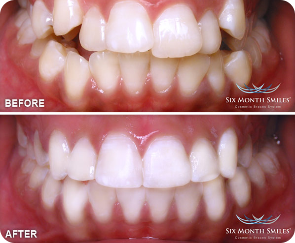 sixmonthsmiles-before-after 1