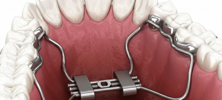 How Do Palate Expanders Work?
