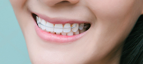 Retainers Treatment in St. Louis