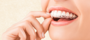 Can Teeth Shift Back After Invisalign Treatment