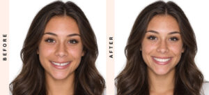 Herbst Appliance Before & After